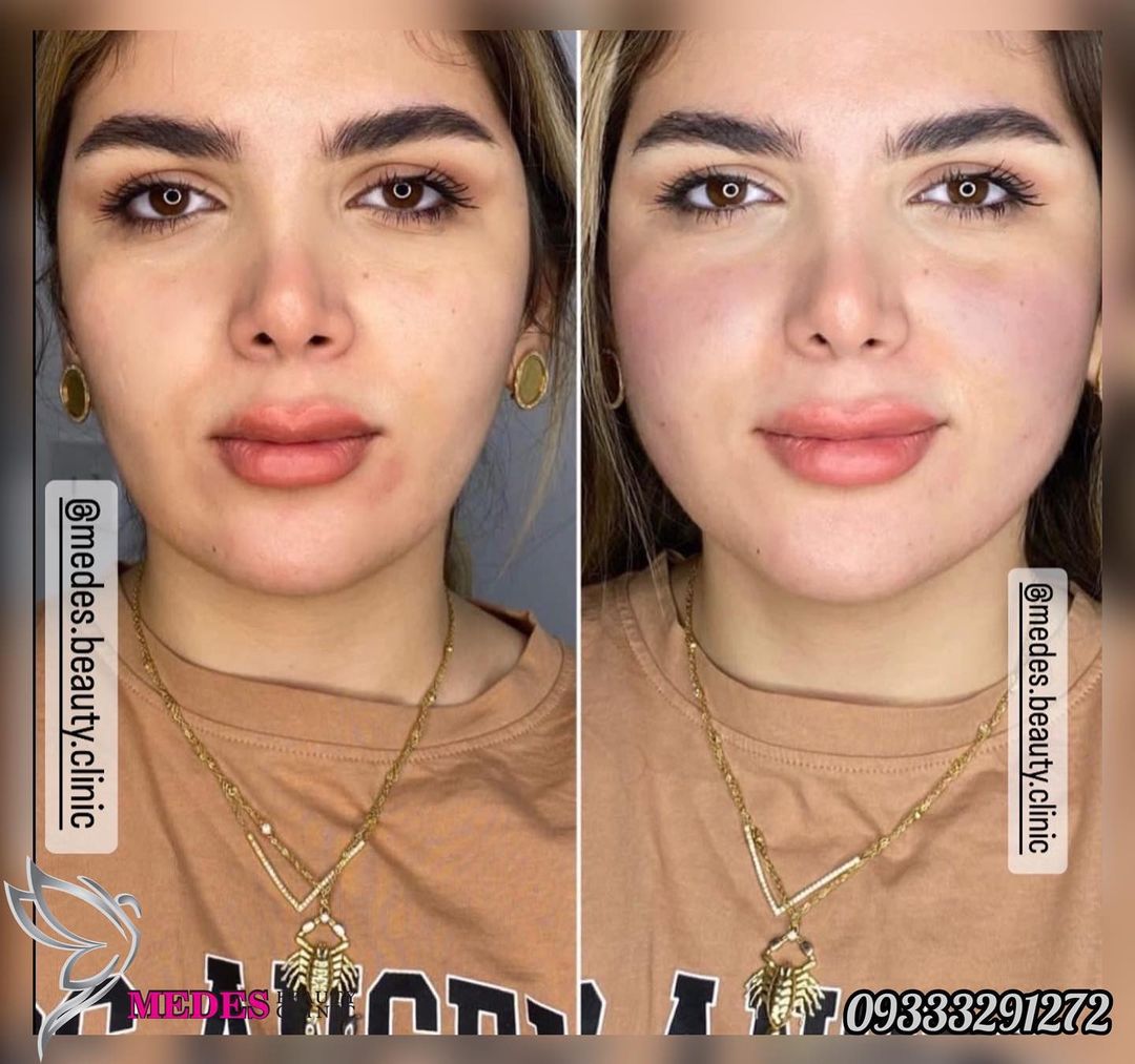 گالری زاویه سازی صورت